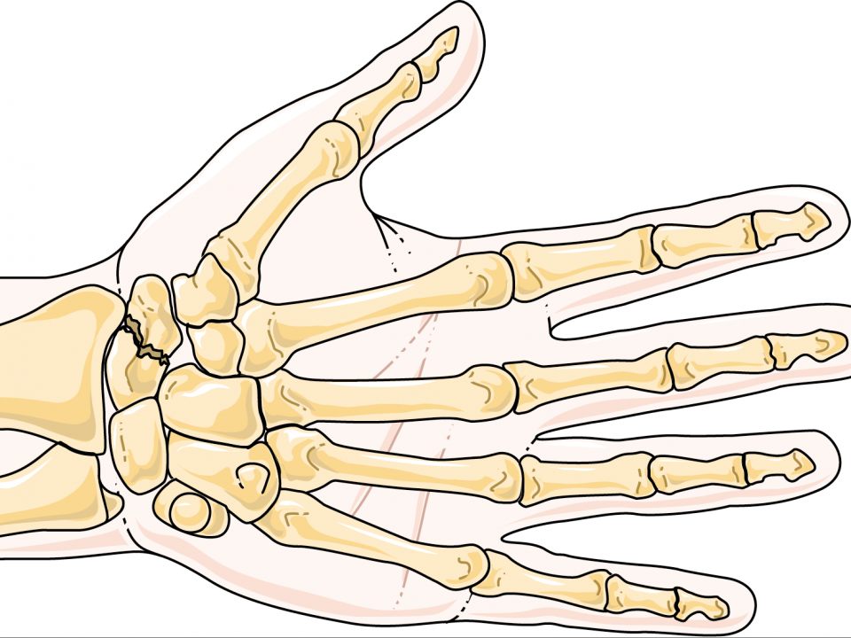 scaphoid fracture