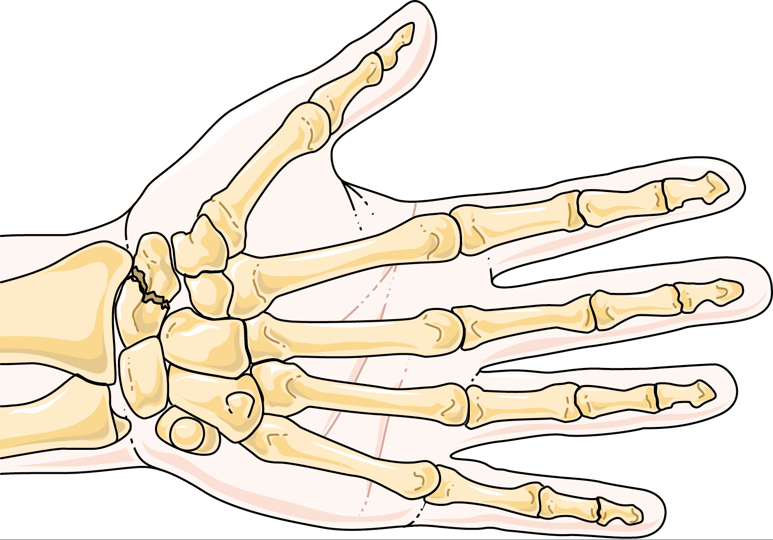 scaphoid fracture