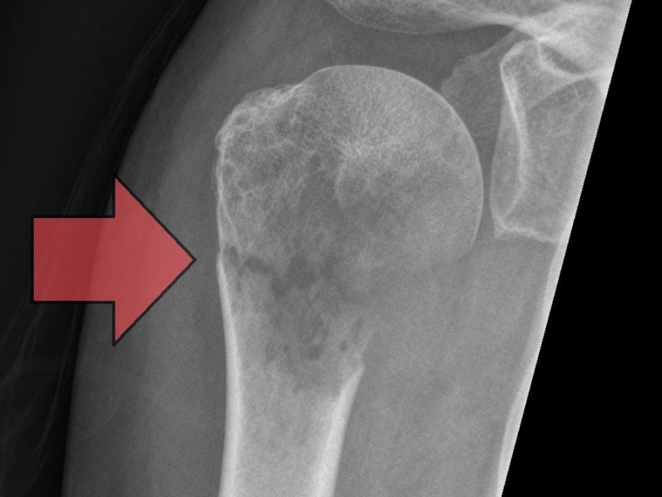 pathological fractures