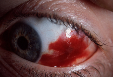 eye trauma
