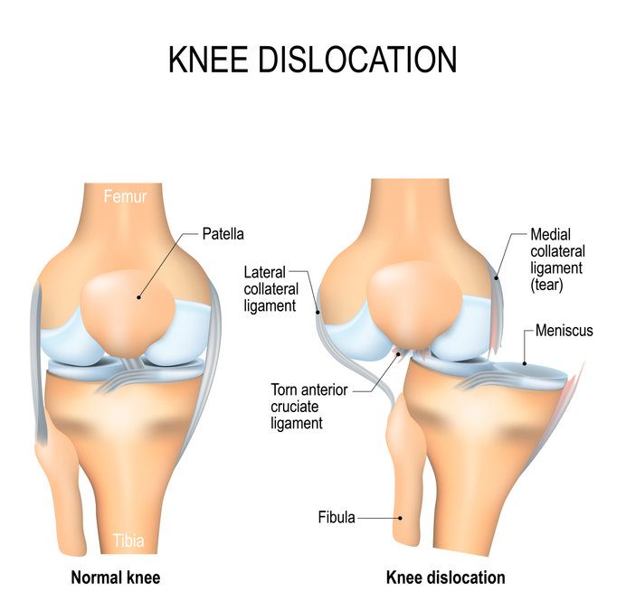 dislocated knee