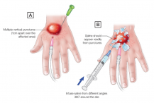 Extravasation Subdermal Injection The Dangers of Cannulation & Extravasation Injuries