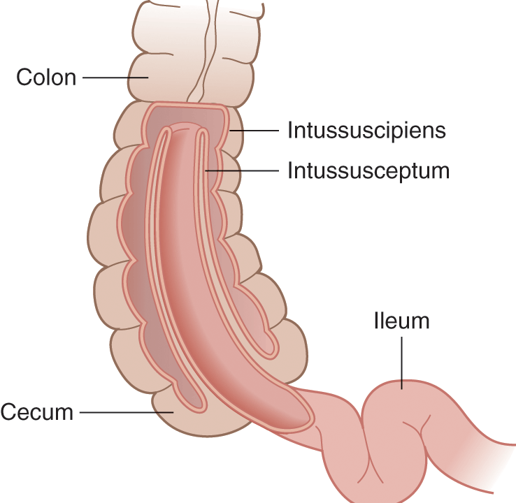 intussusception