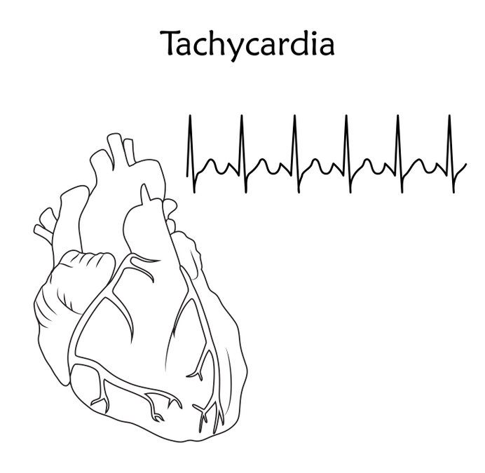 emergency treatment of tachycardia