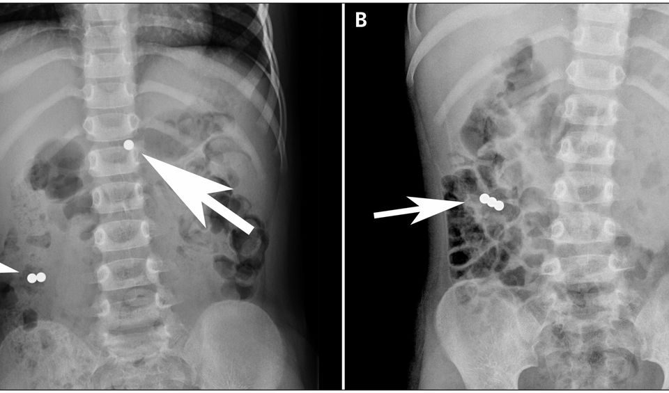 strong magnet ingestion in children