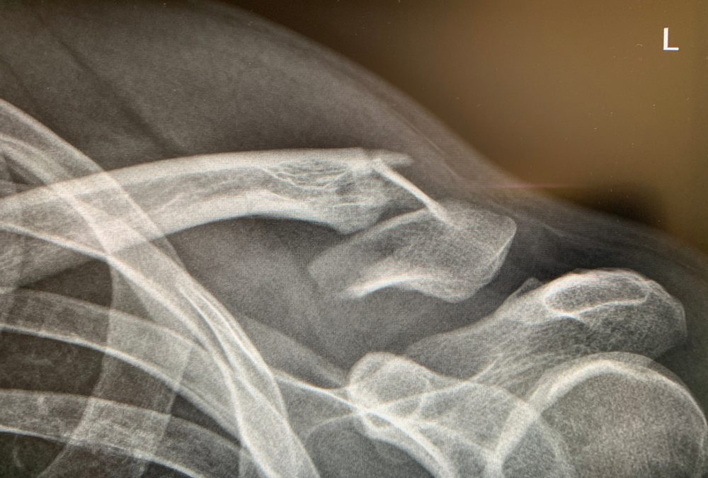 why doctors miss fractures