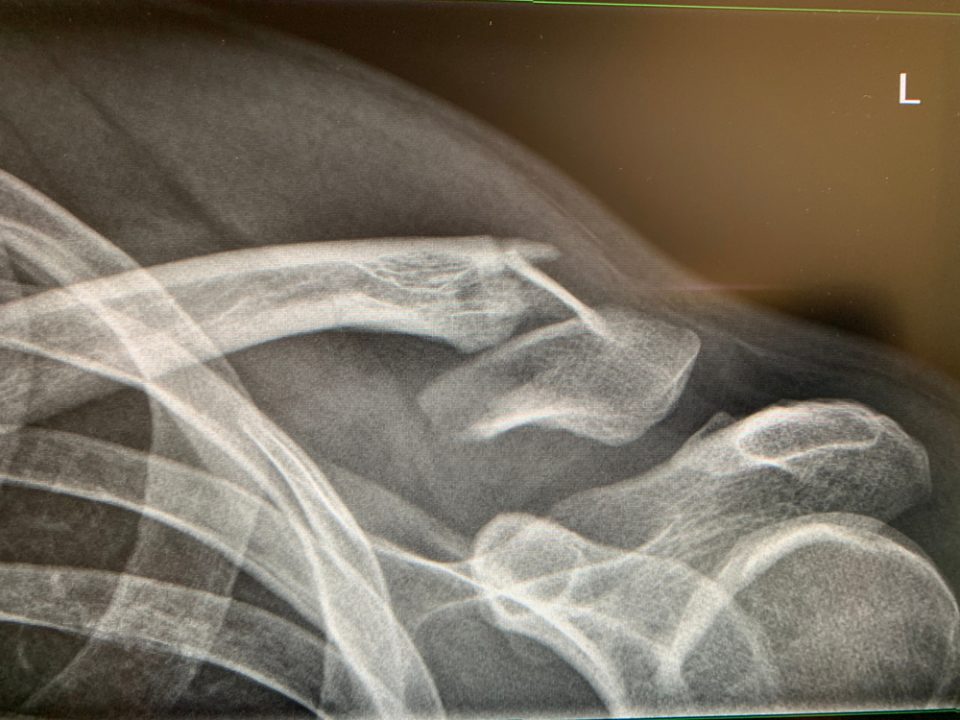 why doctors miss fractures