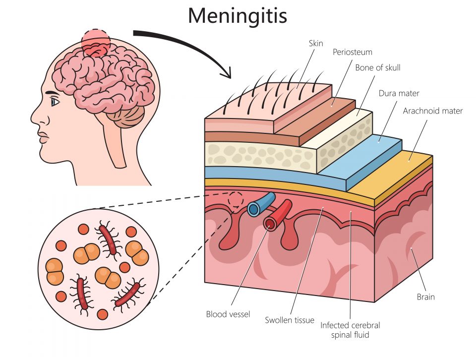 WHO meningitis clinical guidelines
