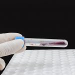 Hyponatraemia