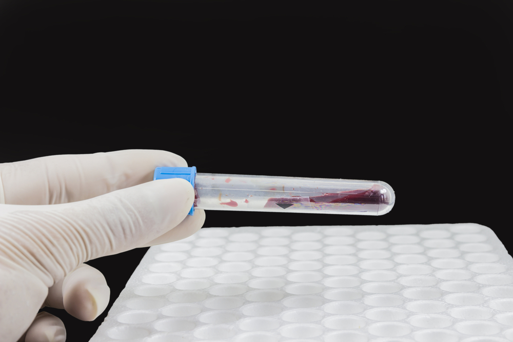 Hyponatraemia